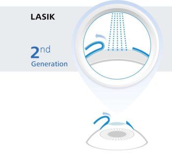 advancements-to-smile-LASIK-cropped-350x320