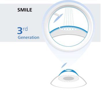 advancements-to-smile-SMILE-cropped-350x320